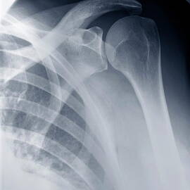 Shoulder X-ray by Sami Sarkis Photography