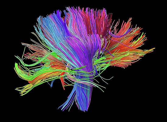 Diffusion Tensor Imaging Photos for Sale by Science Photo Library