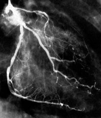 Arteries Wall Art for Sale by Science Photo Library