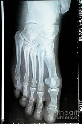 Close Up Photograph - X-ray Image Of A Mature Woman Foot by Sami Sarkis Photography
