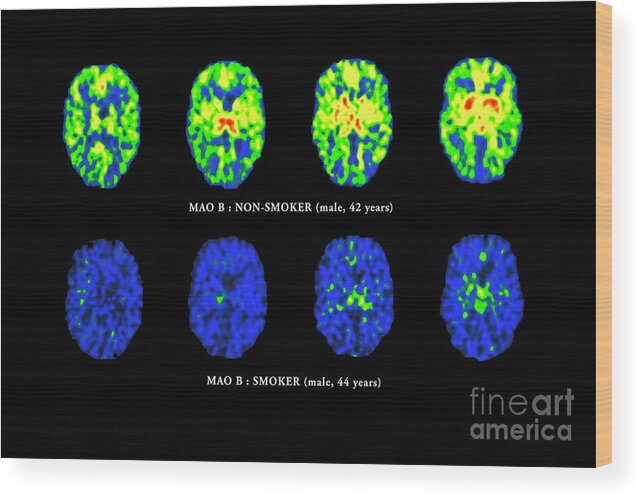 tobacco brain Smoking boosts risk for rare, often fatal, bleeding stroke how does tobacco affect the