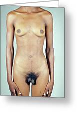 Hermaphrodite Wood Print by Science Photo Library - Science Photo Gallery Hermaphrodite Wood Print by Science Photo Library - Science Photo Gallery